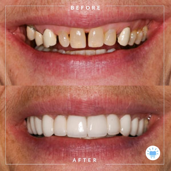 before-after-westmountdentist-2-Edit